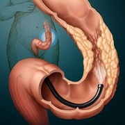 Colitis a szigmabél - tünetek és kezelés