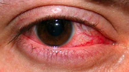 Tratamentul conjunctivitelor la ochi la adulți, simptome și cauze