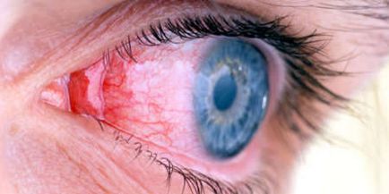 Кон'юнктивіт очей лікування у дорослих, симптоми і причини