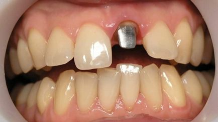 Коронка на зуб як ставлять, боляче чи ставити