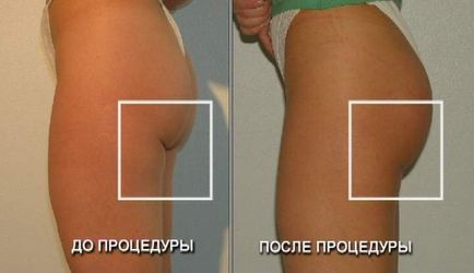 Corectarea feselor - gluteoplastie - ridicarea feselor - corectarea feselor în clinică - meditez