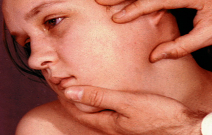 Alattomos következménye orrpolip gyermekeknél - sialadenitis