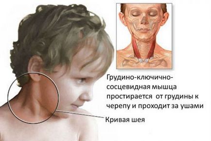 Torticollis la adulți și copii simptome de formă musculară, de ajustare, tratament