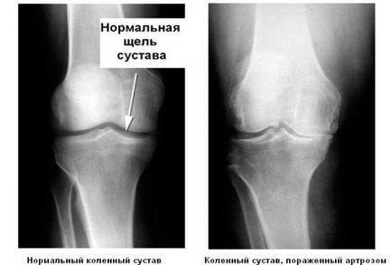 Лікування артрозу 1 ступеня колінного суглоба