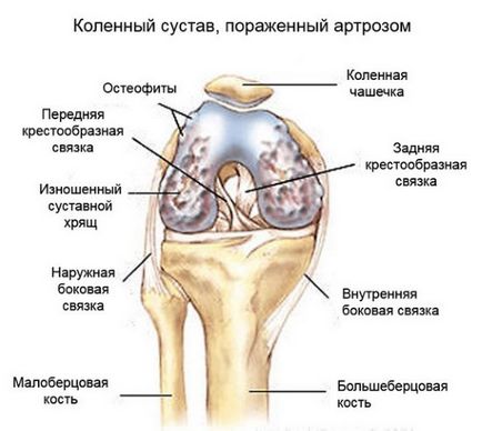 Лікування артрозу 1 ступеня колінного суглоба