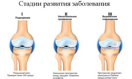 Tratamentul artrozei 1 grad al articulației genunchiului