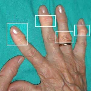 Tratamentul durerii în articulațiile mâinilor și modul de tratare a tumorilor, articulațiilor rănit