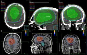 Tratamentul glioblastomului vaccinului cerebral, chimioterapie