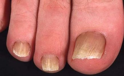Лікування грибка нігтів ніг сіллю
