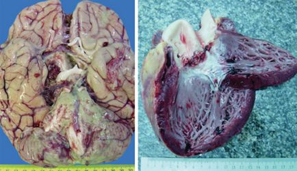 Tratamentul și prevenirea infecțiilor cu hemofilie