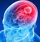 Tratamentul tumorilor cerebrale - tratament chirurgical