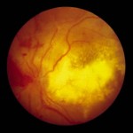 Tratamentul detașării retinei