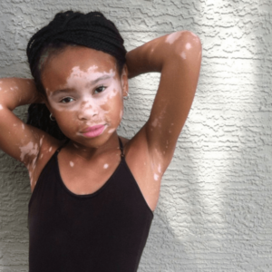 Tratamentul vitiligo la copii