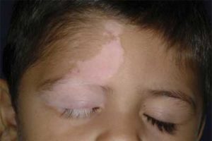 Tratamentul vitiligo la copii