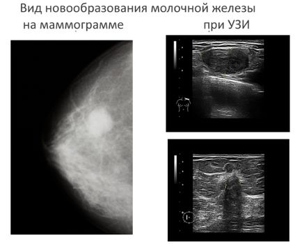 Mamografie sau ultrasunete mamar care este mai bună și mai precisă decât acestea diferă și la ce să aleagă