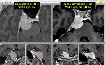 Meningiomul este o tumoare cerebrală benignă