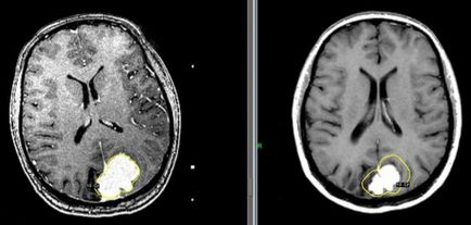 agyi meningióma - CyberKnife® kezelés