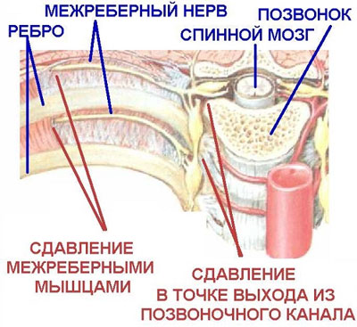 Nevralgia intercostală - cauze, consecințe și factori provocatori