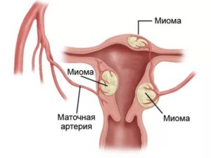 миома на матката по време на бременността и риска от функции