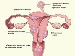 Міома матки при вагітності небезпека і особливості