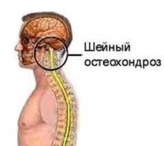 Чи можна паритися в лазні при остеохондрозі корисні поради та рекомендації