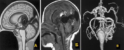Mrt expert, mr-angiografie (cercetarea venelor unui creier)