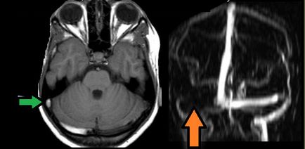 MRI szakértő, MR angiográfia (tanulmány az agyi vénák)