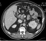 Mtskt cavitatea abdominala, avantajele metodei