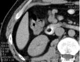 Mtskt cavitatea abdominala, avantajele metodei