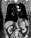 Mtskt cavitatea abdominala, avantajele metodei