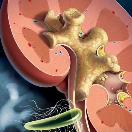 Multicysteza de rinichi (displazie) la copii și adulți