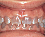 Dentinogeneza imperfectă - cauze, simptome, diagnostic și tratament