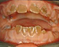 Dentinogenesis имперфекта - причини, симптоми, диагностика и лечение