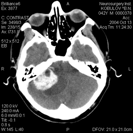 Neuroimaging vizsgálatok (folytatjuk tumornövekedés) képalkotó vizsgálatok