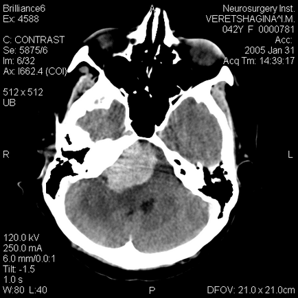 Neuroimaging tanulmányok (gamma-kés) képalkotó vizsgálatok