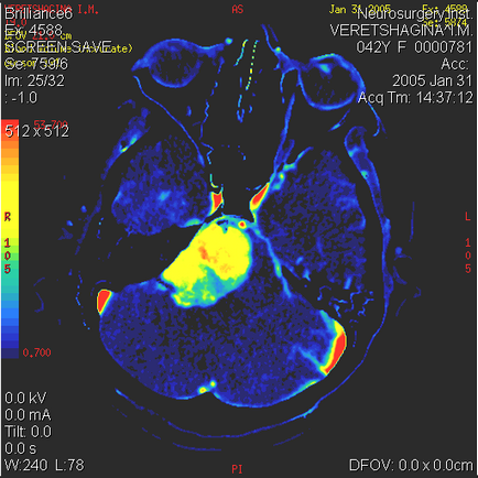 Neuroimaging tanulmányok (Leksell gamma-kés) képalkotó vizsgálatok