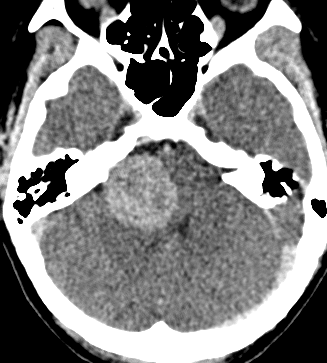 Neuroimaging tanulmányok (Burdenko) képalkotó vizsgálatok