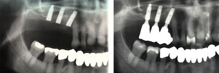 Tehnologii noi de implantare fără plastice osoase