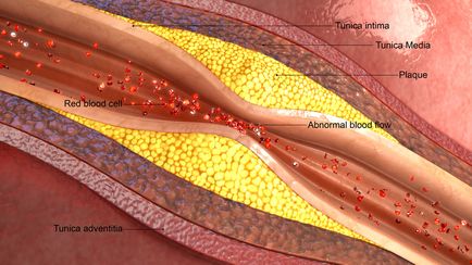 Ocluzia arterei subclavice de ce apare și cum se tratează