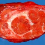 Пухлина печінки - аденома, журнал медичних статей «молодий лікар»