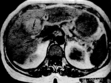 Tumorile ficatului - adenom, revista de articole medicale 