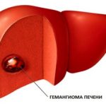 Tumorile ficatului - adenom, revista de articole medicale 
