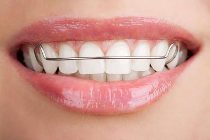 Ортодонтична пластина на зуби дитини