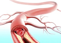Hipotensiunea arterială ortostatică sau colapsul ortostatic și tratamentul