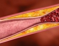 Hipotensiunea arterială ortostatică sau colapsul ortostatic și tratamentul