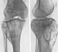 Osteodystrophiában - okai, tünetei, diagnózisa és kezelése