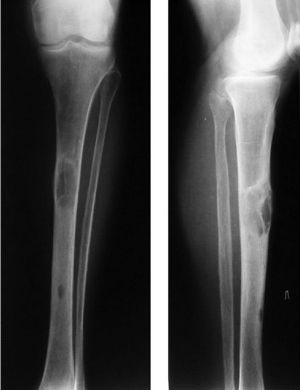 Osteodystrofia - clasificare, simptome și tratament