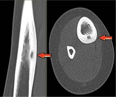 Osteomul osului - tratament, simptome, cauze