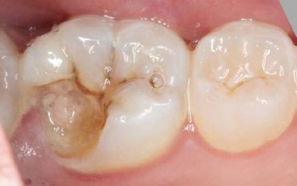 Відкололася пломба, край зуба що робити, лікування, профілактика ушкодження