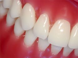 Gingival hpv treatment